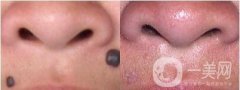 做E光點(diǎn)痣調(diào)節(jié)果怎么樣?果保持時(shí)間多久?