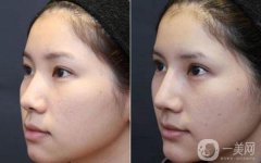 做隆鼻改良短鼻調(diào)節(jié)果怎么樣?果保持時(shí)間多久?