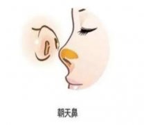 矯正朝天鼻的果怎么樣？注意事項(xiàng)有哪些？