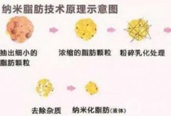 什么是納米脂肪填充？有哪些作用