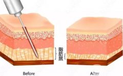 水動力吸脂價格的影響因素有哪些？有什么副作用？