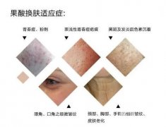 果酸換膚適合哪些人？不適合哪些人？