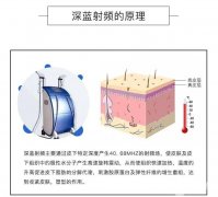 深藍(lán)射頻除皺有什么優(yōu)點(diǎn)？哪些因素決定深藍(lán)射頻除皺的價格