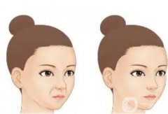 哪些因素影響玻尿酸填充法令紋的價格？法令紋填充后需要注意什么？