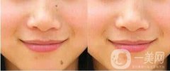做冷凍去痣調(diào)節(jié)果怎么樣?果保持時間多久?