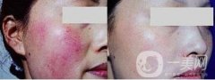 做E光去紅血絲調(diào)節(jié)果怎么樣?果保持時間多久?