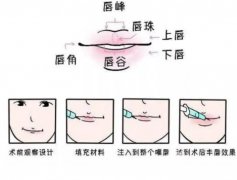 玻尿酸豐唇的優(yōu)點(diǎn)是什么，果如何？