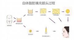 自體脂肪填充后的風(fēng)險(xiǎn)主要有哪些？