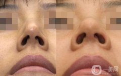 做鼻孔整形調(diào)節(jié)果怎么樣?果保持時間多久?