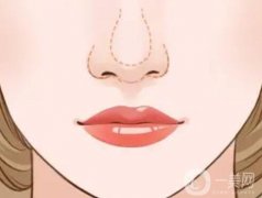 鼻頭縮小有哪些優(yōu)勢？會反彈嗎