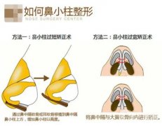玻尿酸可以注射鼻小柱嗎？鼻小柱延長(zhǎng)有哪些常用方法