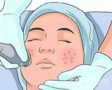 彩光嫩膚可以去除痘印嗎？如何護(hù)理？