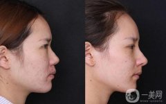 做隆鼻調節(jié)果怎么樣?果保持時間多久?