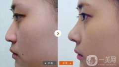 做墊鼻基底調(diào)節(jié)果怎么樣?果保持時間多久?