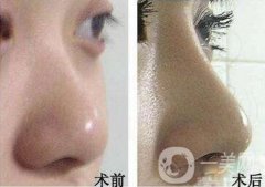 做自體脂肪墊鼻基底調(diào)節(jié)果怎么樣?果保持時(shí)間多久?
