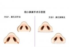 鼻翼縮小有哪些手術(shù)方法？手術(shù)前應(yīng)該注意什么？