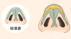 鼻頭縮小手術(shù)的優(yōu)點(diǎn)和缺點(diǎn)是什么？