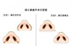 鼻翼縮小有什么后遺癥嗎？后遺癥是什么？