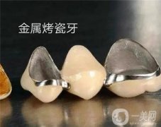 做烤瓷牙有哪些必要性？松動脫落怎么修復(fù)