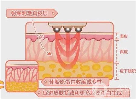 熱瑪吉電波拉皮*果怎么樣？維持多久？