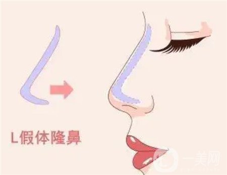 鼻頭縮小手術(shù)圖,鼻頭縮小注意事項(xiàng)