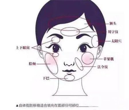 臉部自體脂肪填充價(jià)格一般是多少？*果好不好？