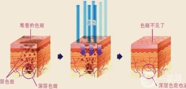 手術祛痣價格