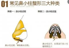 什么材料可以延長鼻小柱？有哪些手術方法？