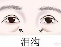 玻尿酸填充淚溝有副作用嗎？