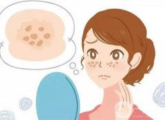 容易導(dǎo)致毀容的祛斑方法？這幾個(gè)一定要謹(jǐn)慎