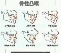 骨性嘴凸有必要做正頜手術(shù)嗎？骨性嘴凸矯正多少錢？