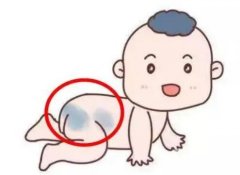怎么避免激光去除胎記的復(fù)發(fā)？