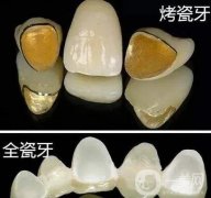 烤瓷牙有哪些種類？一起來看看吧