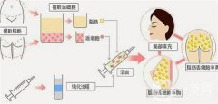 面部填充脂肪后多久能用洗面奶？多久能用護(hù)膚品？