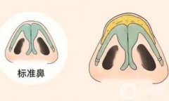填充鼻基底有哪些材料?
