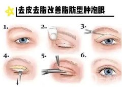 腫泡眼有哪些分類？腫泡眼的類型有哪些