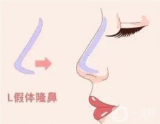 怎么防止L型假體穿透鼻尖？鼻假體取出后會增生嗎？