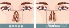 鼻中隔偏曲的癥狀有哪些？一定要手術嗎