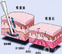 負(fù)壓吸脂術(shù)的手術(shù)方法？有哪些優(yōu)勢(shì)？