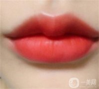 哪些人適合玻尿酸隆唇？多長(zhǎng)時(shí)間可以軟化呢