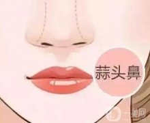 蒜頭鼻的矯正的原理和步驟？