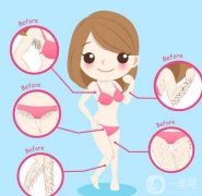 激光脫毛多少錢？禁忌人群分別有哪些？