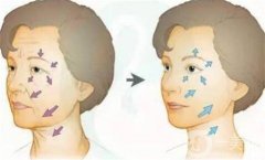 全臉脂肪填充怎么樣？優(yōu)勢有哪些？哪些人又不能做呢
