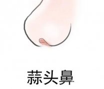 怎么矯正大蒜鼻？如何不手術(shù)改良大蒜鼻？