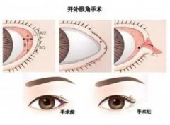 不建議開(kāi)外眼角的原因是什么？