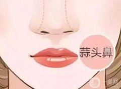 大蒜鼻整形有后遺癥嗎？恢復(fù)自然需要多長時間？
