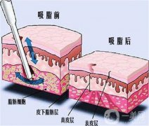 抽脂對身體會產(chǎn)生什么影響嗎？