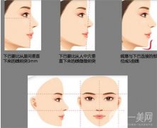 墊下巴要腫多長時間？多久可以吃東西