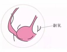 副乳切除后會(huì)復(fù)發(fā)嗎？有什么后遺癥