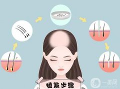 發(fā)際線整形有哪些危害?